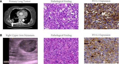 Durable Response to Immunotherapy With Antiangiogenic Drug in Large-Cell Lung Carcinoma With Multiple Fulminant Postoperative Metastases: A Case Report